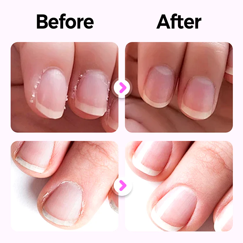 💜Réduction limitée à 50 %💜 2025 Nouveau stylo de soin des ongles 3 en 1 amélioré - Image 2
