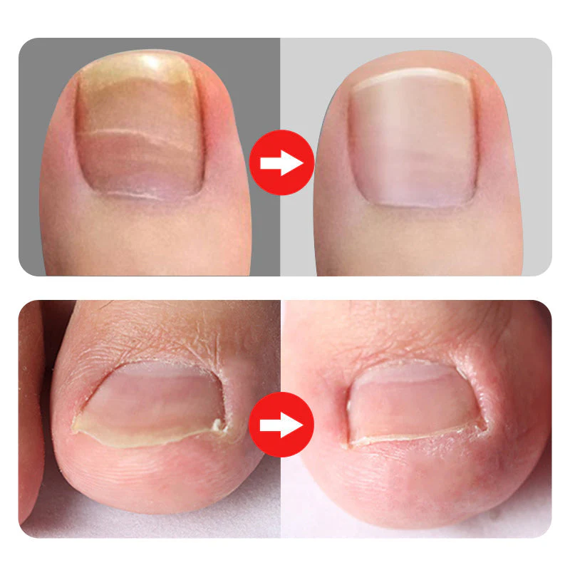 📢📢60 % DE RÉDUCTION !!⏰Coupe-ongles professionnels pour ongles incarnés 7 pièces - Image 3